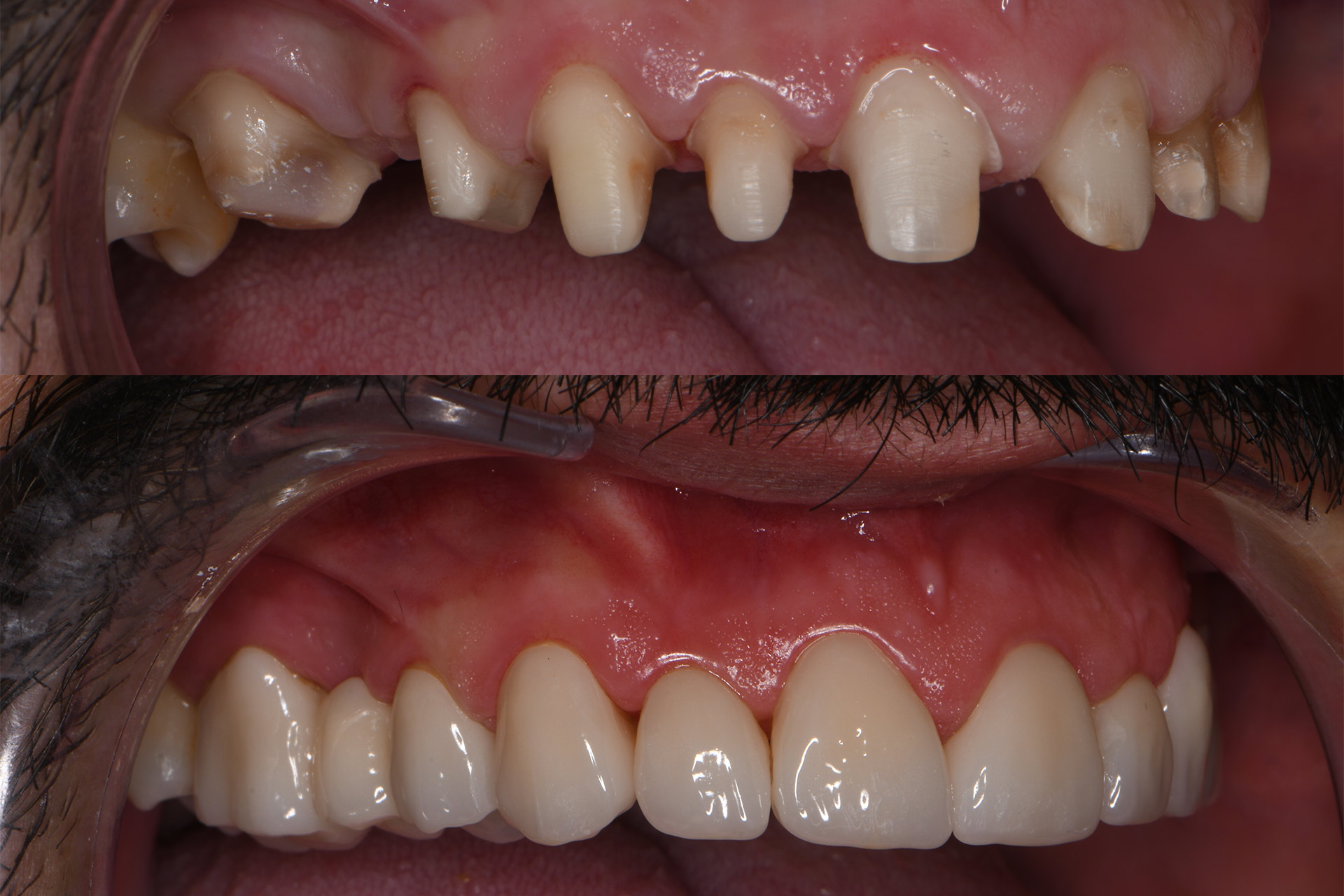 Fylld tand med komposit efter tandlagning i Göteborg