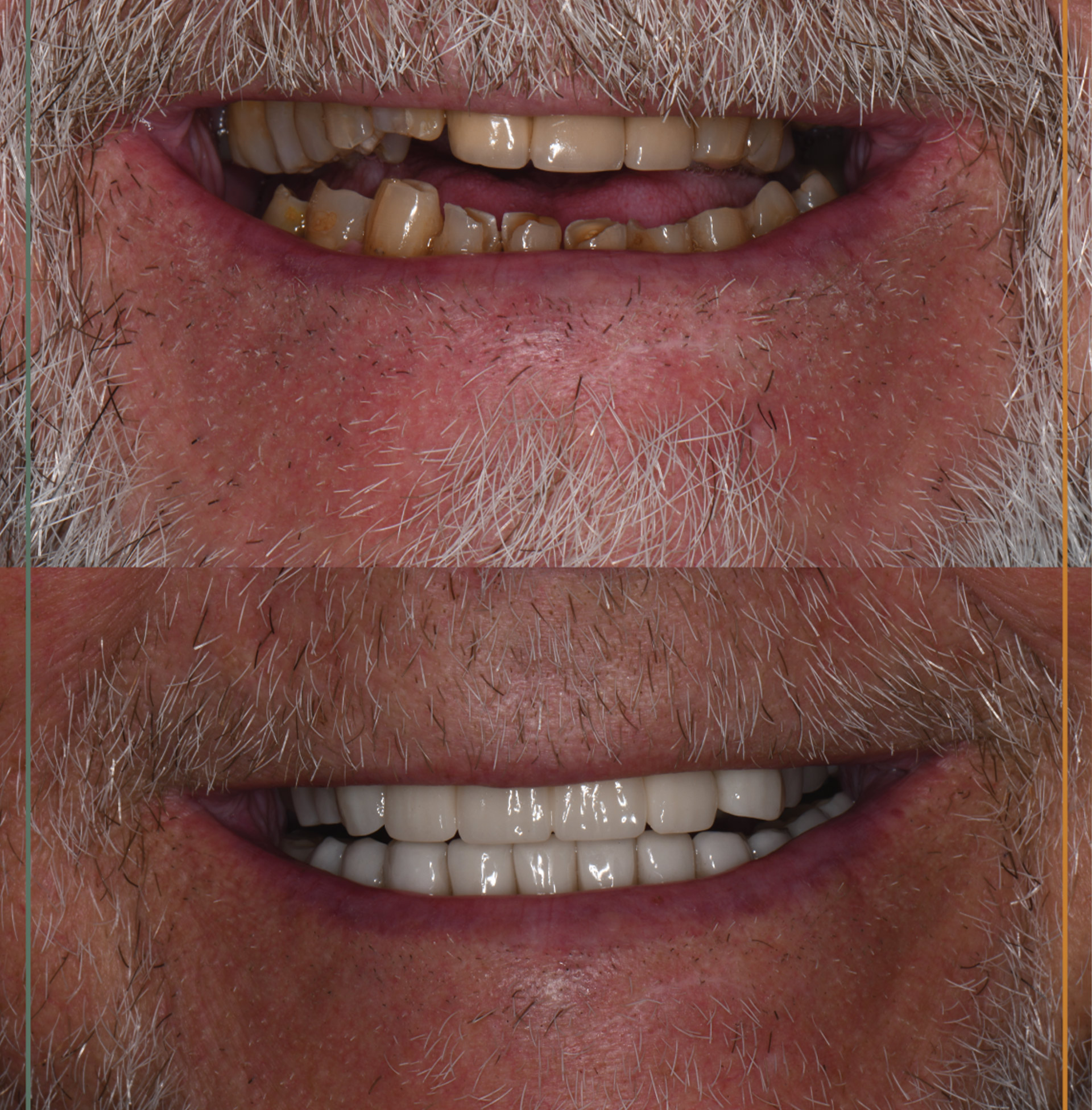 Hål i tand före tandlagning hos Quality Dental i Göteborg