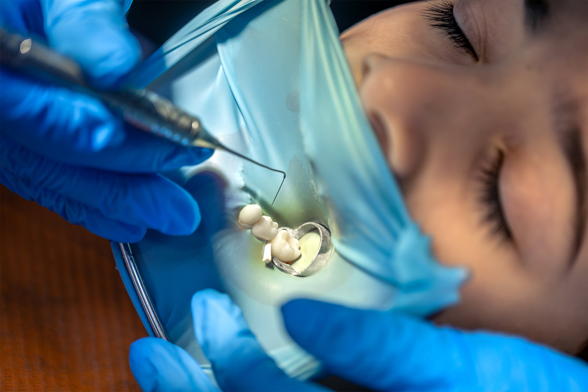 Patient efter rotfyllning i Göteborg hos Quality Dental