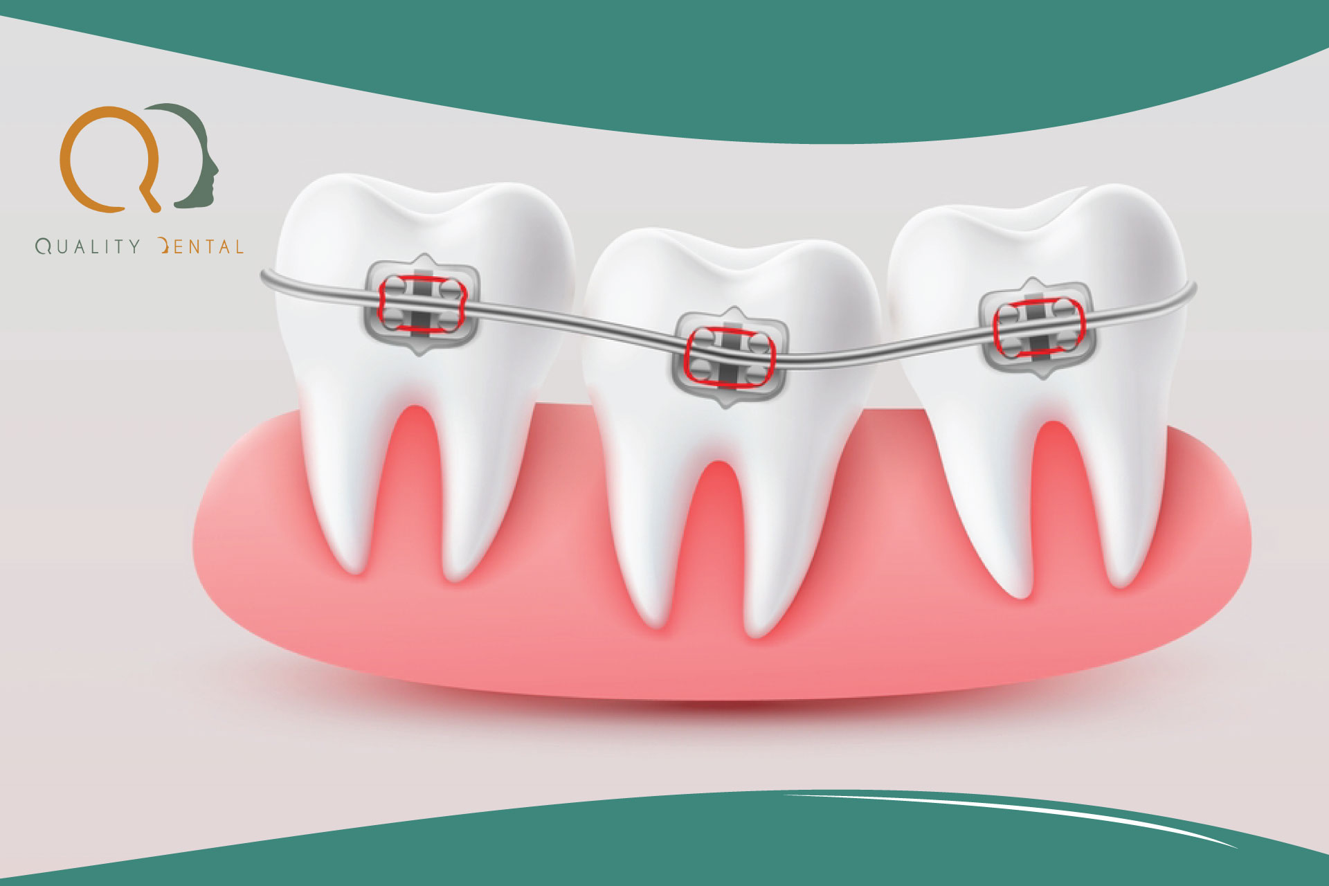 Patient visar en genomskinlig aligner hos Quality Dental i Göteborg